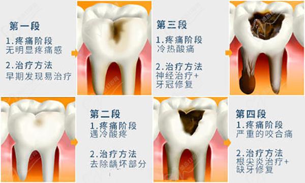 齲齒的形成