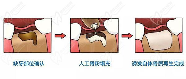 骨量不足怎么做種植牙
