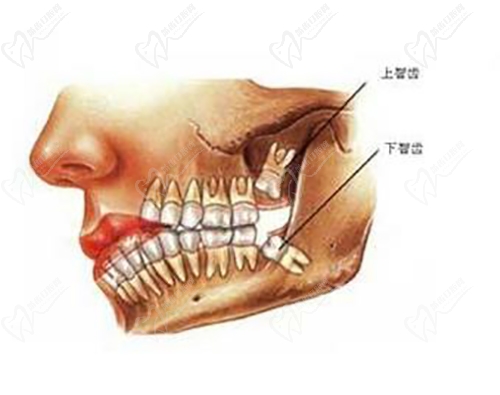 拔智齒會(huì)有后遺癥