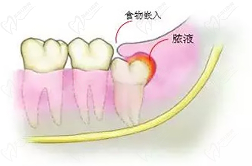 智齒每隔一段時(shí)間就發(fā)炎怎么辦
