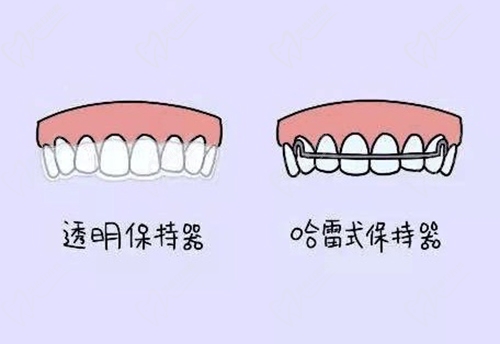 牙齒保持器類型