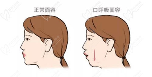 口呼吸