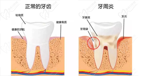牙周炎