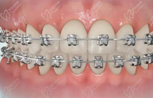 牙齒金屬托槽矯正