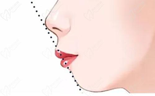 嘴凸可以通過托槽做矯正