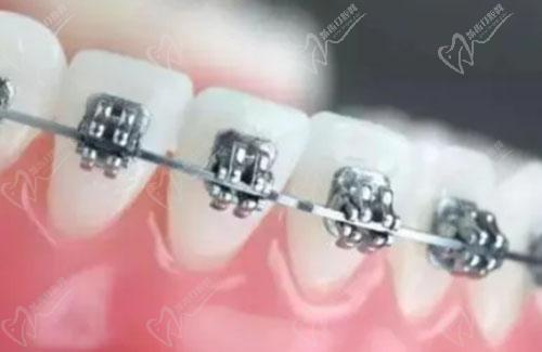 金屬托槽牙齒矯正