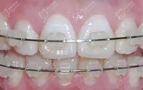 陶瓷半固定牙齒矯正