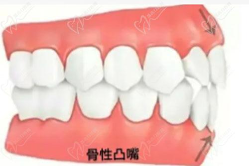 骨性凸嘴矯正方式