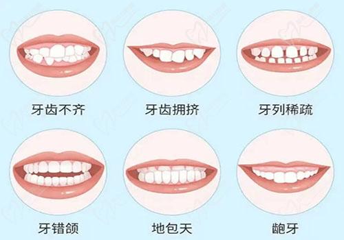 牙齒矯正的適用癥