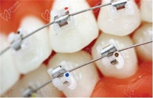 陶瓷自鎖托槽矯正