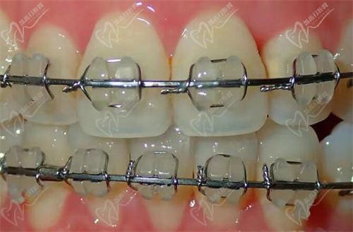 陶瓷自鎖托槽矯正