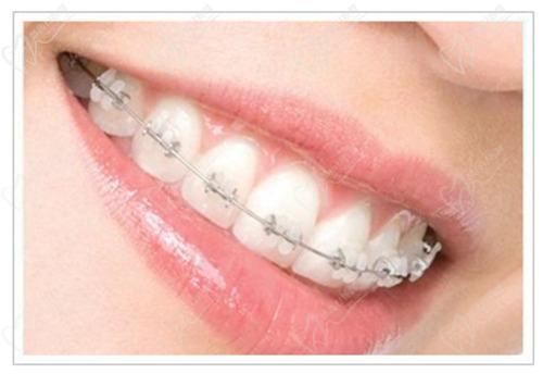 牙齒矯正