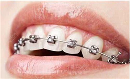 牙齒矯正