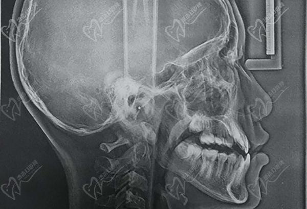 牙齒不齊一定要矯正嗎？從時(shí)間上來看