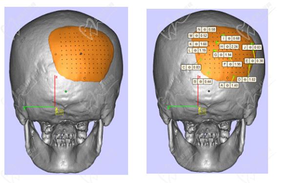 上海后腦勺整形醫(yī)院排名二——上海時(shí)光整形外科醫(yī)院后腦勺整形
