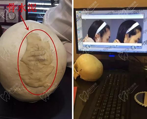 上海后腦勺整形醫(yī)院排名一——上海九 院后腦勺整形