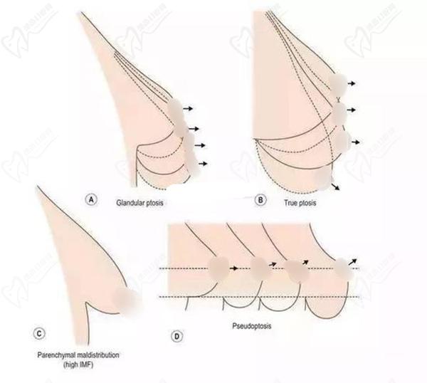2024北京聯(lián)合麗格醫(yī)院隆胸整形收費標準