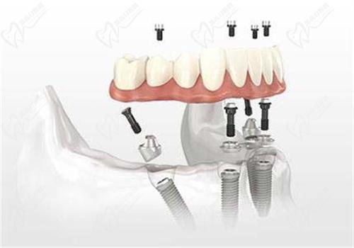 韓國(guó)種植牙的種植體有哪幾種