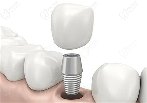 韓國(guó)種植牙的種植體有哪幾種