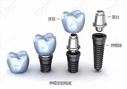韓國(guó)種植牙的種植體有哪幾種