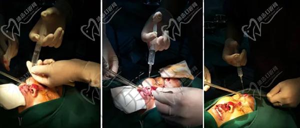 上海海華醫(yī)院安洪賓醫(yī)生疤痕修復(fù)