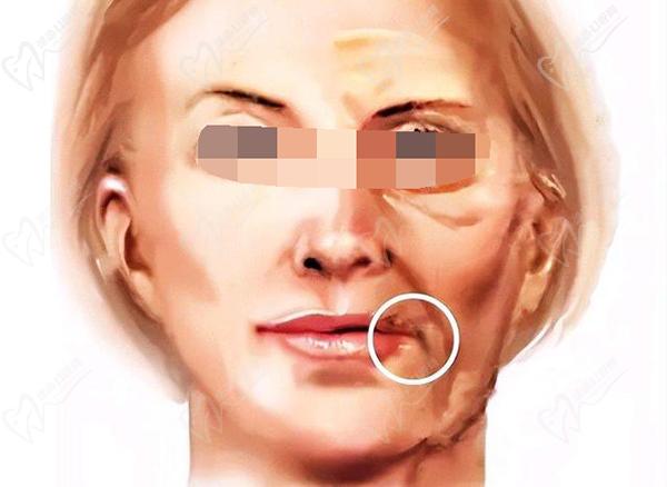 上海海華醫(yī)院安洪賓醫(yī)生拉皮除皺優(yōu)勢(shì)