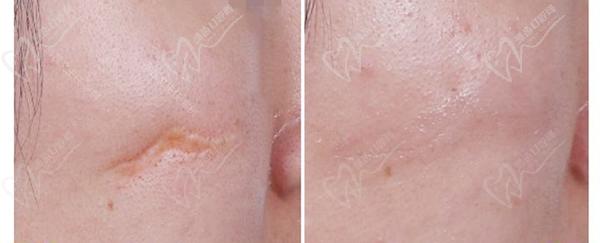 上海海華醫(yī)院安洪賓醫(yī)生疤痕修復(fù)優(yōu)勢(shì)