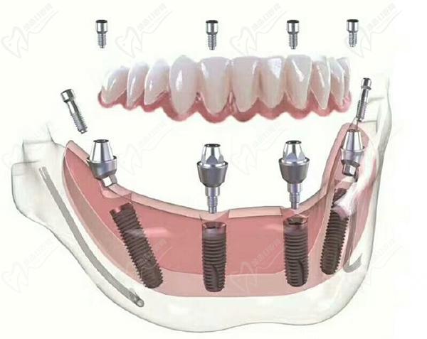 、瑞士iti種植牙半口即刻種植優(yōu)勢