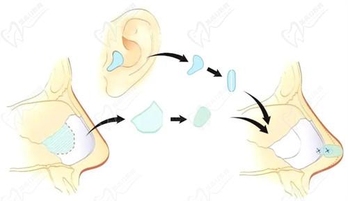 上海張群醫(yī)生做耳畸形修復(fù)怎么樣