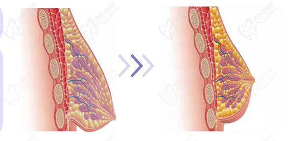 深圳南雅整形醫(yī)院做提胸手術(shù)怎么樣？