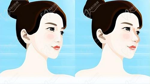成都唐建華醫(yī)生鼻子做的好么