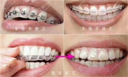 二、拜博口腔正畸價(jià)格的影響因素