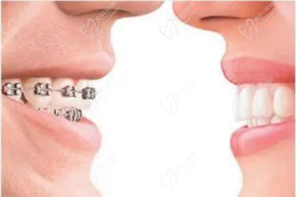 怎么區(qū)分正畸mbt與roth托槽？對(duì)比兩者區(qū)別來看哪個(gè)好附價(jià)格