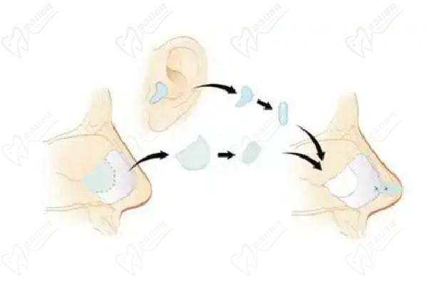 北京鼻整形宮鳳勇醫(yī)生核心技術(shù)解析