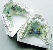 牙齒擴(kuò)弓后容易反彈嗎？擴(kuò)弓矯正牙齒的后遺癥有哪些？