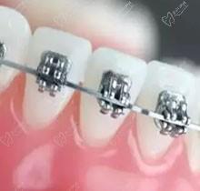 矯正嘴凸牙套大概要多少錢？解答21歲箍牙還來(lái)得及嗎