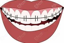 牙齒矯正后會(huì)不會(huì)容易松動(dòng)？有人牙齒矯正7年后變形是真的嗎