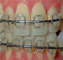 醫(yī)生為什么不推薦陶瓷牙套矯正？鋼牙套好還是陶瓷的好??？