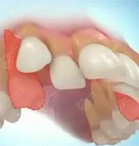 為什么說(shuō)矯正千萬(wàn)不要拔牙？來(lái)看14歲正畸拔四顆牙后遺癥