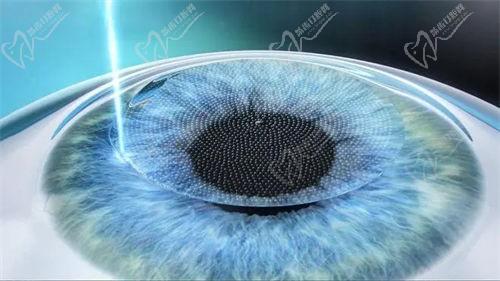 翟愛琴做激光近視手術(shù)怎么樣？技術(shù)太牛價(jià)格也合理坐診上海和平