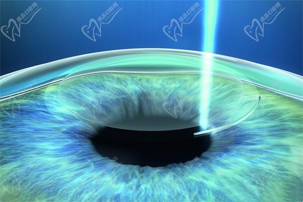 趙立全手術(shù)做的好嗎？坐診上海醫(yī)大眼科飛秒/晶體近視手術(shù)拿手