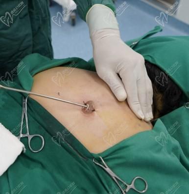 黃學峰消除富貴包是怎么樣切除的？黃學峰富貴包的手術過程